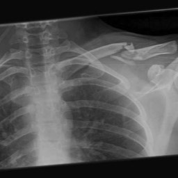 Clavicle Fracture Treatment Sydney