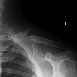 Clavicle Fracture Treatment Sydney
