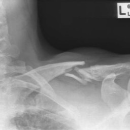 Clavicle Fracture Treatment Sydney