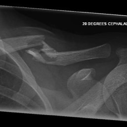 Clavicle Fracture Treatment Sydney