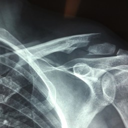 Distal Clavicle Fracture Treatment Sydney