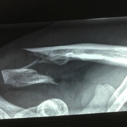 Distal Clavicle Fracture Treatment Sydney