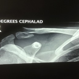 Distal Clavicle Fracture Treatment Sydney