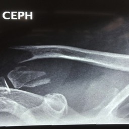 Distal Clavicle Fracture Treatment Sydney