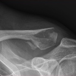 Distal Clavicle Fracture Treatment Sydney