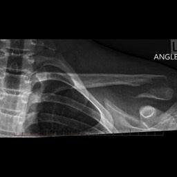 Distal Clavicle Fracture Treatment Sydney