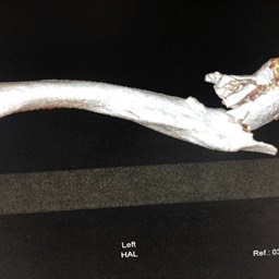 Distal Clavicle Fracture Treatment Sydney