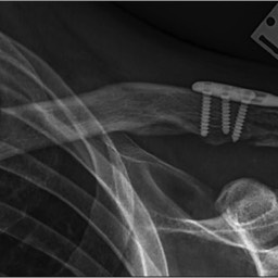 After Distal Clavicle Fracture Surgery with Plate Sydney