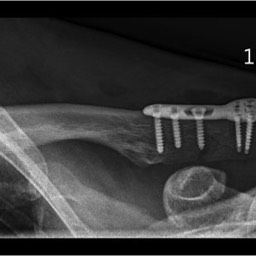 After Distal Clavicle Fracture Surgery with Plate Sydney