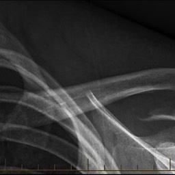 After Distal Clavicle Fracture Surgery No Plate Sydney