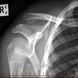 After Distal Clavicle Fracture Surgery No Plate Sydney