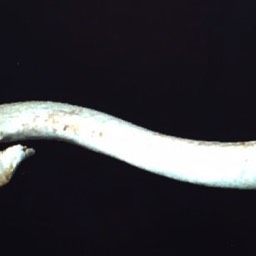 After Distal Clavicle Fracture Surgery No Plate Sydney