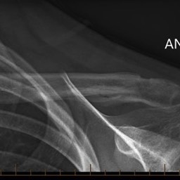 After Distal Clavicle Fracture Surgery No Plate Sydney