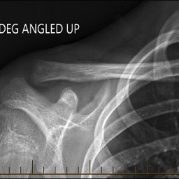 After Distal Clavicle Fracture Surgery No Plate Sydney