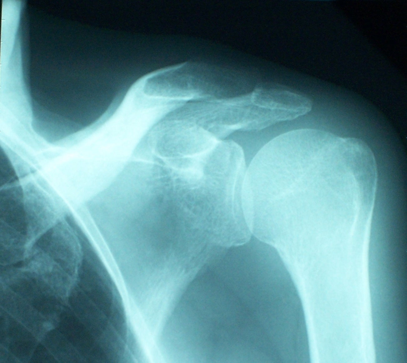 Shoulder Osteoarthritis Surgery