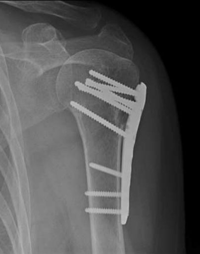 Xray showing plate and screws proximal humerus fracture surgery
