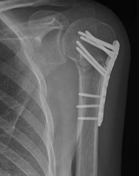 Xray showing plate and screws proximal humerus fracture surgery