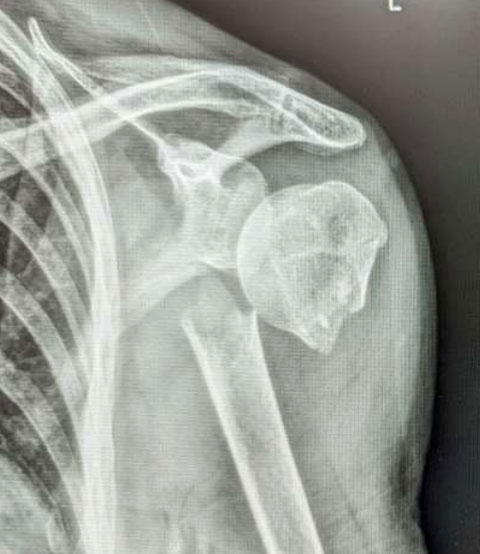 X-ray showing proximal humerus fracture