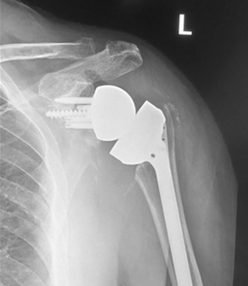 Shoulder after reverse replacement surgery