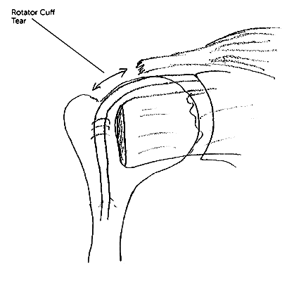 Reverse Shoulder Replacement Surgery Sydney