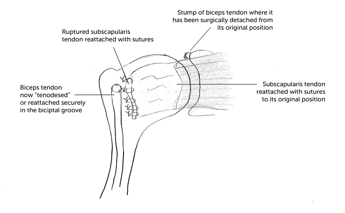 Subscapularis Repair Sydney