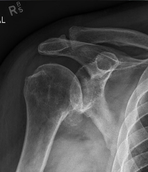 Shoulder before replacement surgery