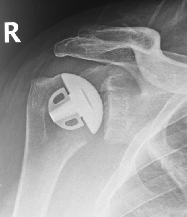 Shoulder after replacement surgery
