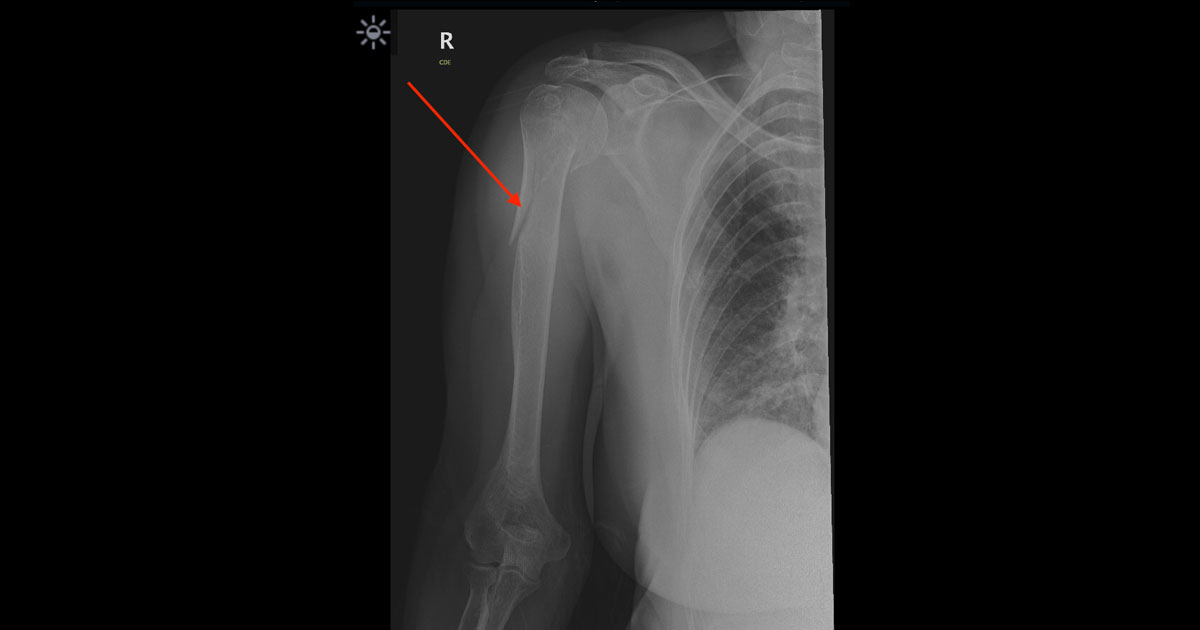 This patient is a 67 year-old female who tripped and fell, landing on her right arm and breaking the top of the humerus (the bone of the upper arm that connects to the shoulder). 
