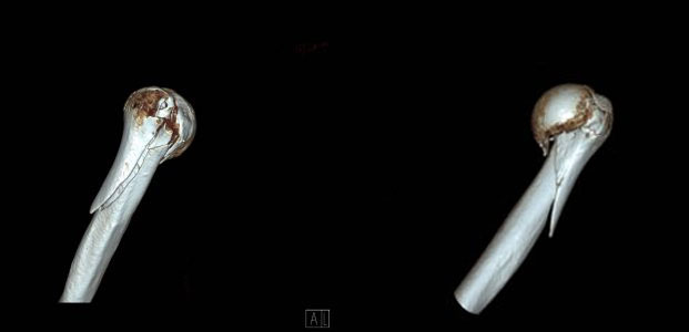 CT showing proximal humerus fracture