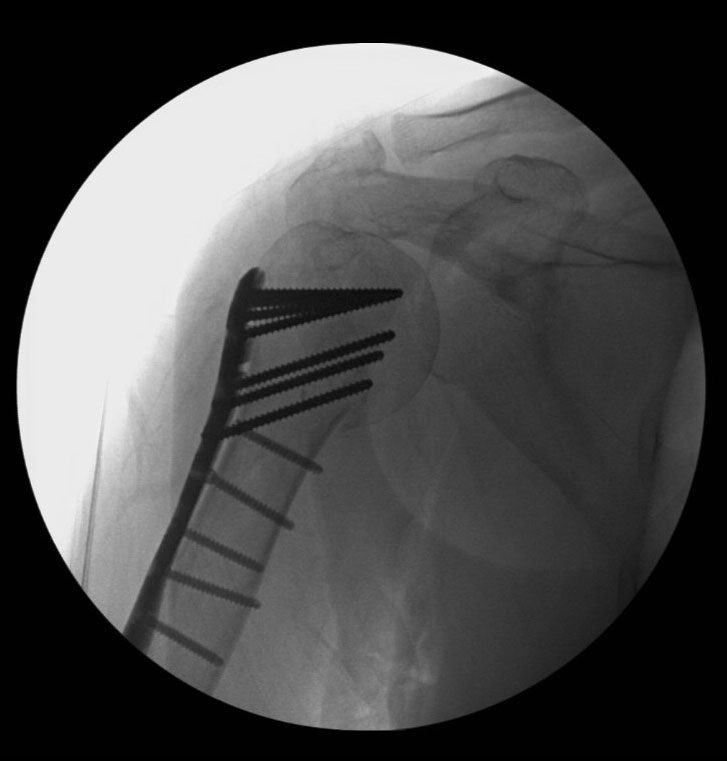 X-ray taken during the operation confirms the anatomy of the bone has been restored.