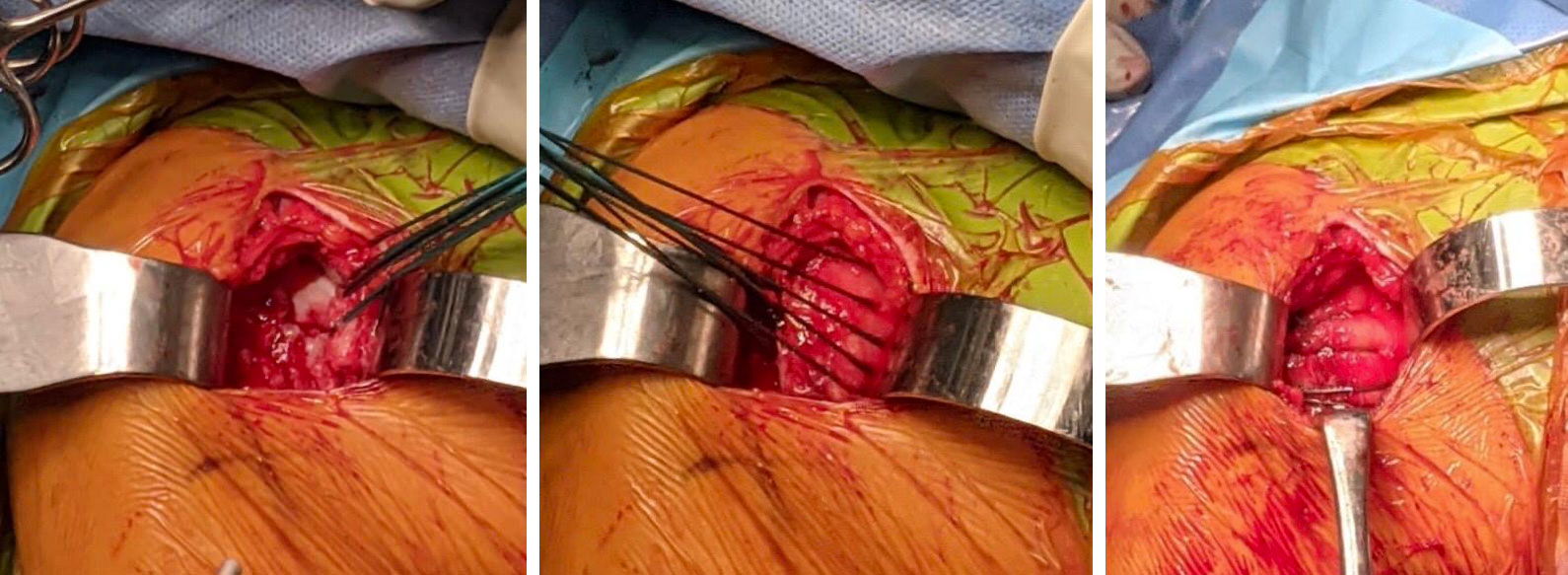 injury was exposed through an incision at the front of the shoulder and strong sutures were passed through the bone fragment and the subscapularis tendon