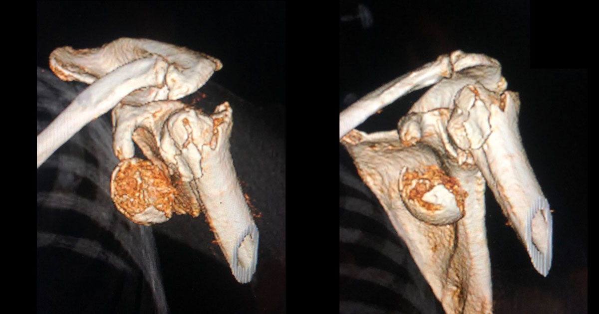 This 76 year-old female suffered a significant fracture of her humerus after tripping and falling up a stair.
