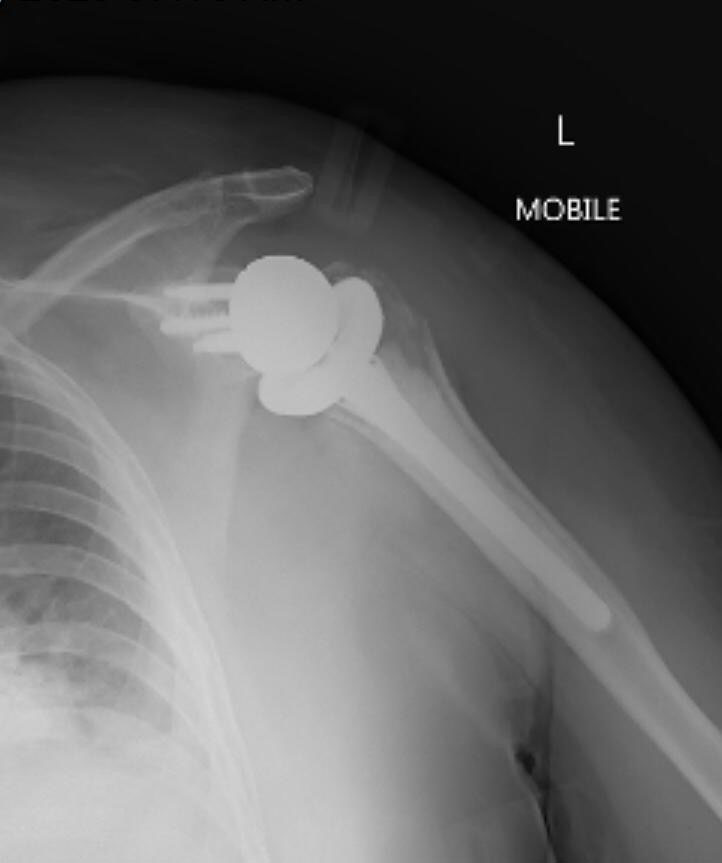 Arthroscopic assessment of the shoulder