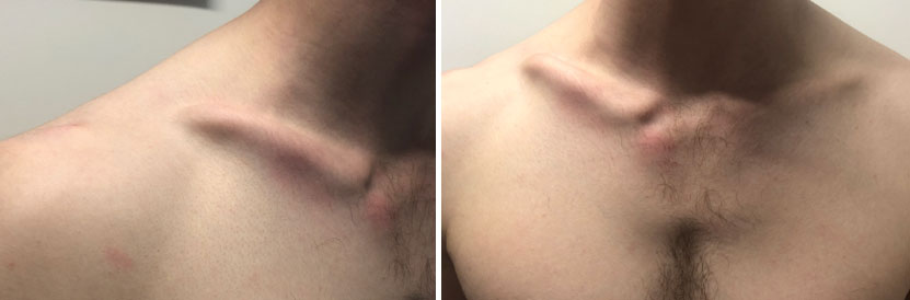 The abnormal position and shape of the clavicle was causing instability and partial dislocation at the joint between the clavicle and the sternum