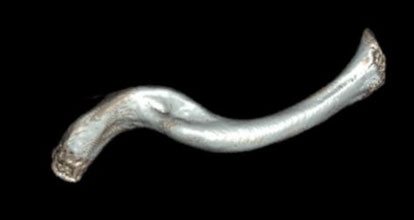 3D CT scan and 3D model of  clavicle malunion used to plan surgery