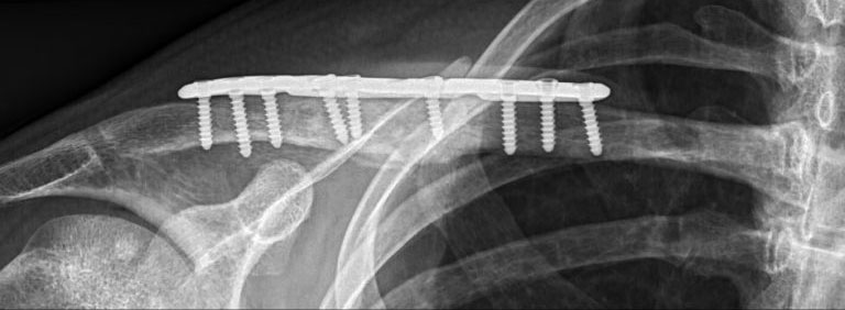 X-rays taken during and after the operation showed that the clavicle was back in its anatomical position.