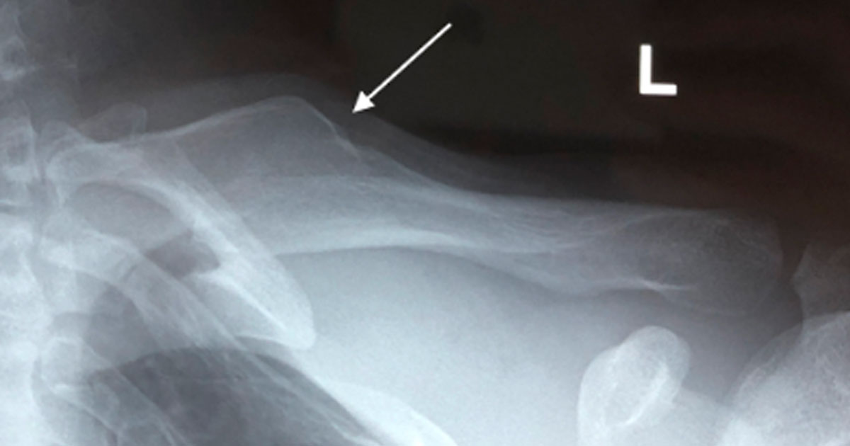 Joe is a 29 year-old male who had successful surgery to treat an old, malunited clavicle fracture that was causing pain and disrupting activity.