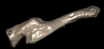 3D CT scan to visualise the bone