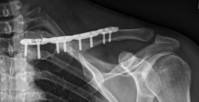 X-rays taken during and after the operation showed that the clavicle was back in its anatomical position.