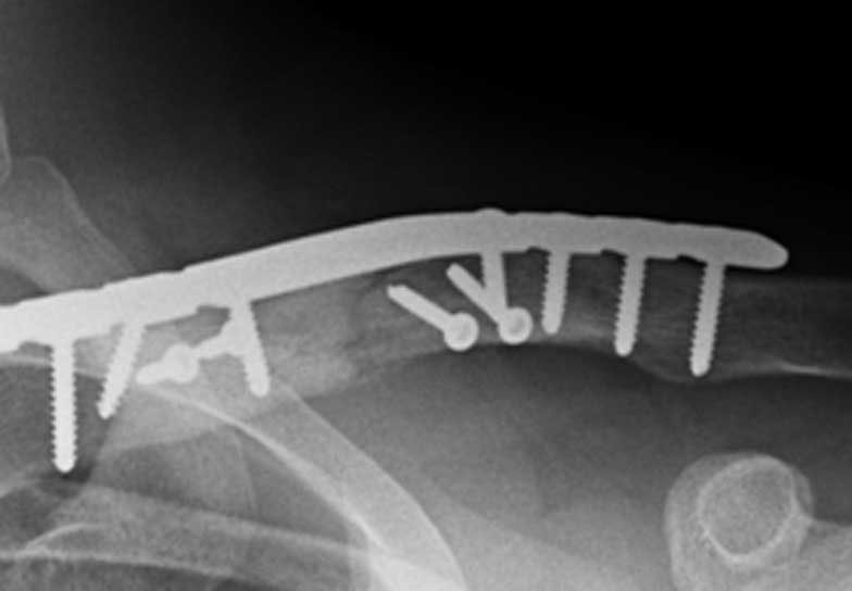 X-ray showing comminuted fracture of the clavicle