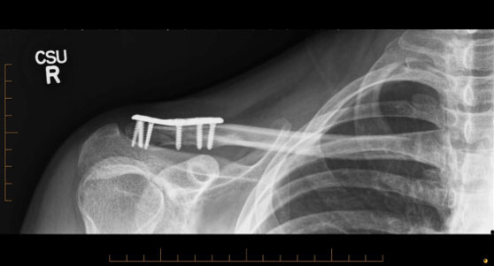 Collarbone realigned with a new custom designed plate