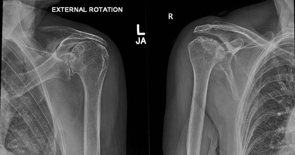 Candidates for a total reverse shoulder replacement will first have a plain x-ray and an MRI taken of their affected shoulder.