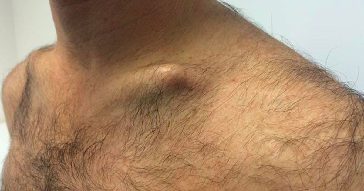 Dr Duckworth answers the most common questions about who can benefit from clavicle surgery and the expected results. 