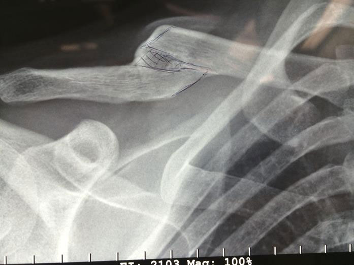 X-Rays of a standard shoulder replacement (left) and a reverse shoulder replacement (right)