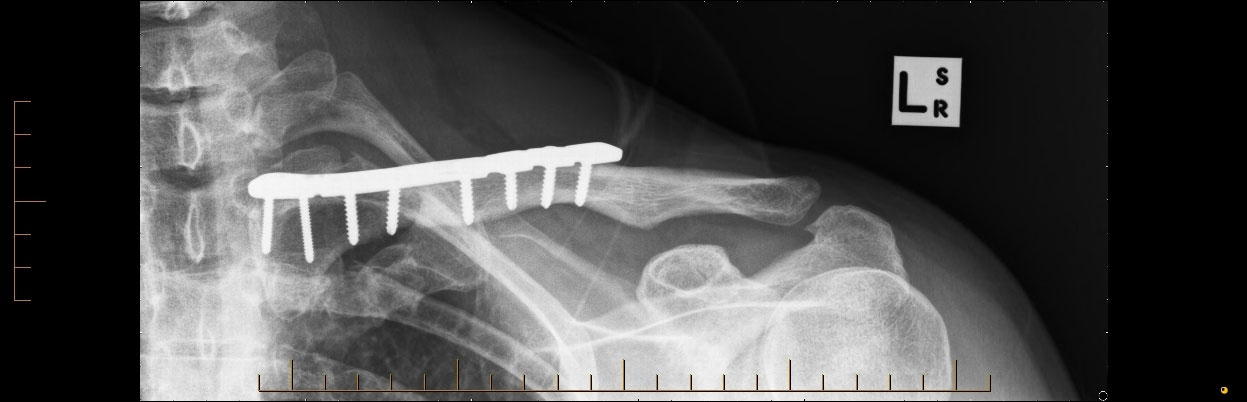 X-Rays of a standard shoulder replacement (left) and a reverse shoulder replacement (right)