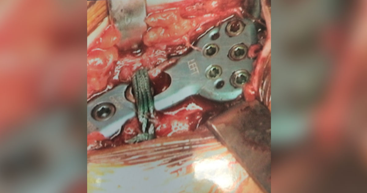 A new surgical device to fix broken collar bones is resulting in faster healing times and better range of movement in patients, according to Sydney orthopaedic surgeon Dr David Duckworth.