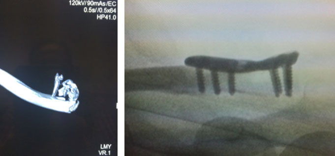X-Rays of a standard shoulder replacement (left) and a reverse shoulder replacement (right)