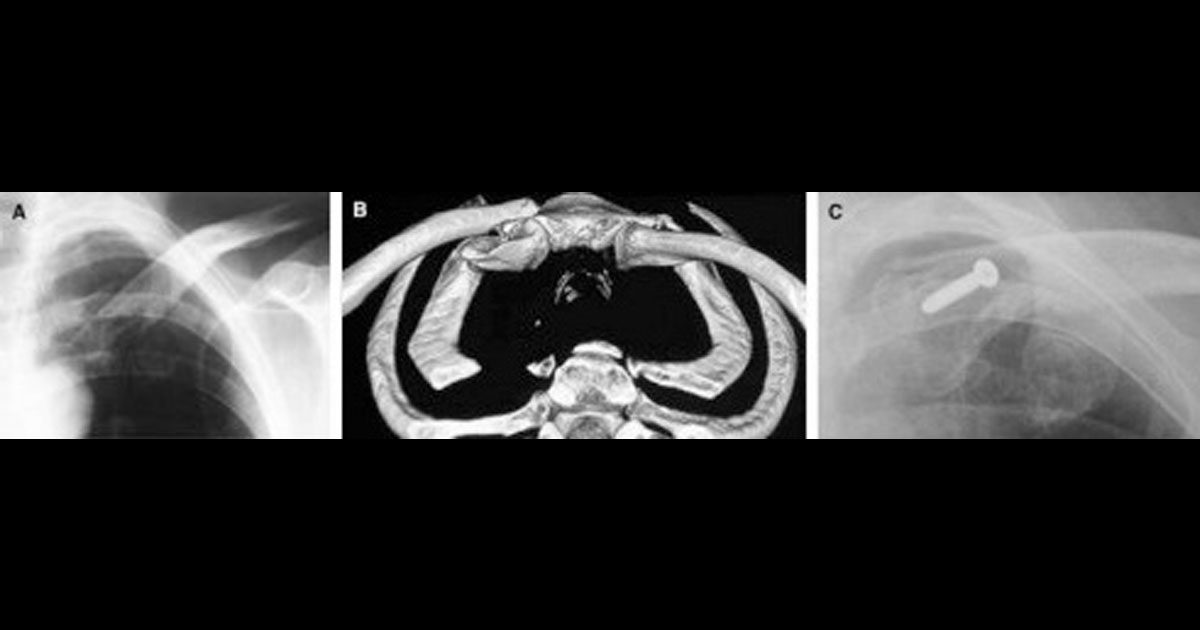 This study reports the results of open reduction and internal fixation on displaced, medial end clavicle fractures, in five adult patients.