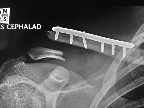 Fracture of distal clavicle next to existing plate after fall from mountain bike