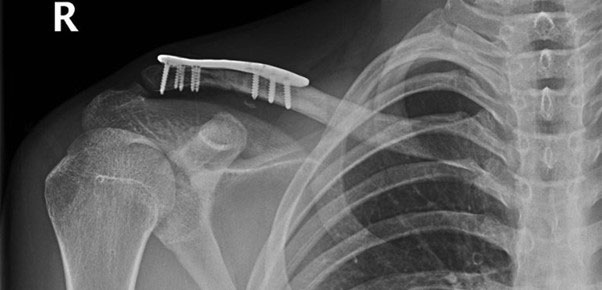 Fracture of distal clavicle next to existing plate after fall from mountain bike